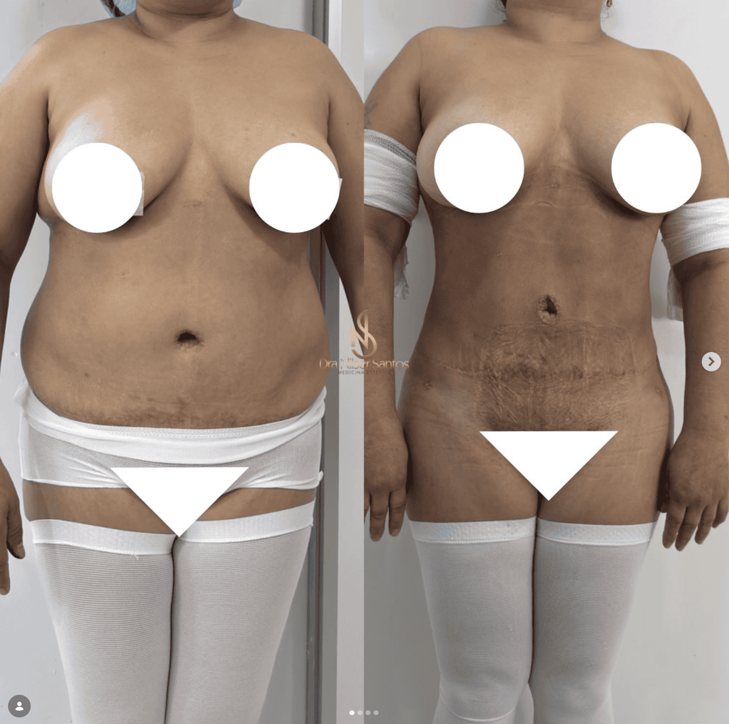 Antes y después · Lipoabdominoplastia + Vaser