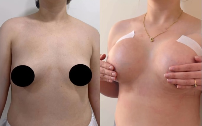 Antes y después · Implantes mamarios