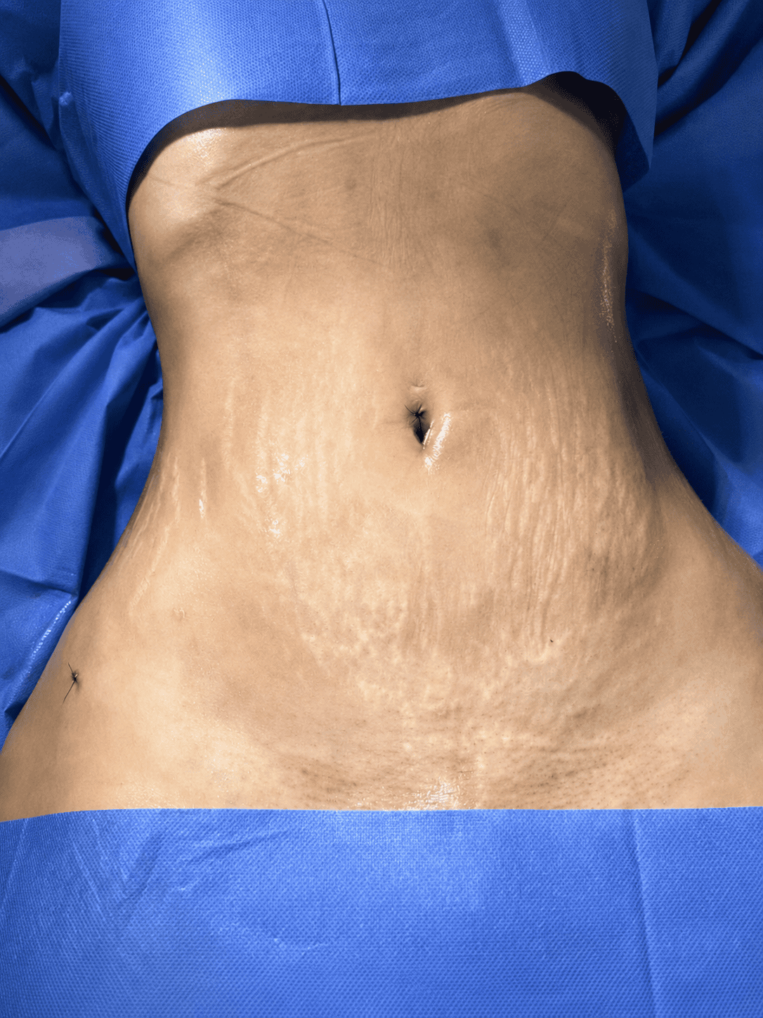 Resultado Lipo Vaser en paciente mujer