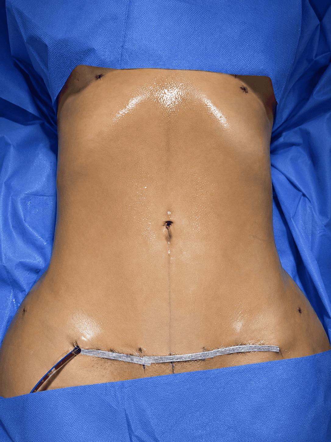 Resultado lipoabdominoplastia con drenaje
