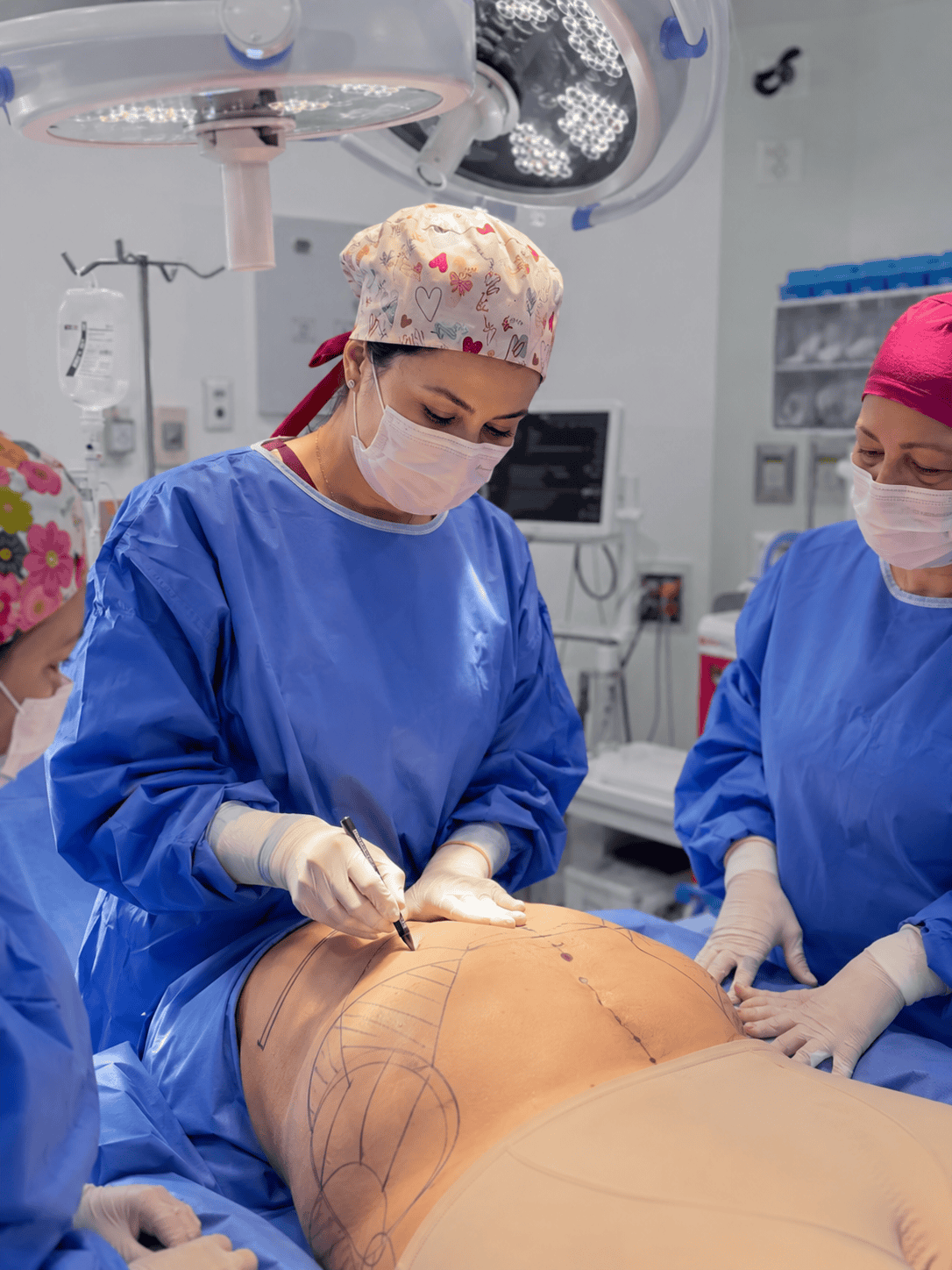 Marcaje preoperatorio para abdominoplastia
