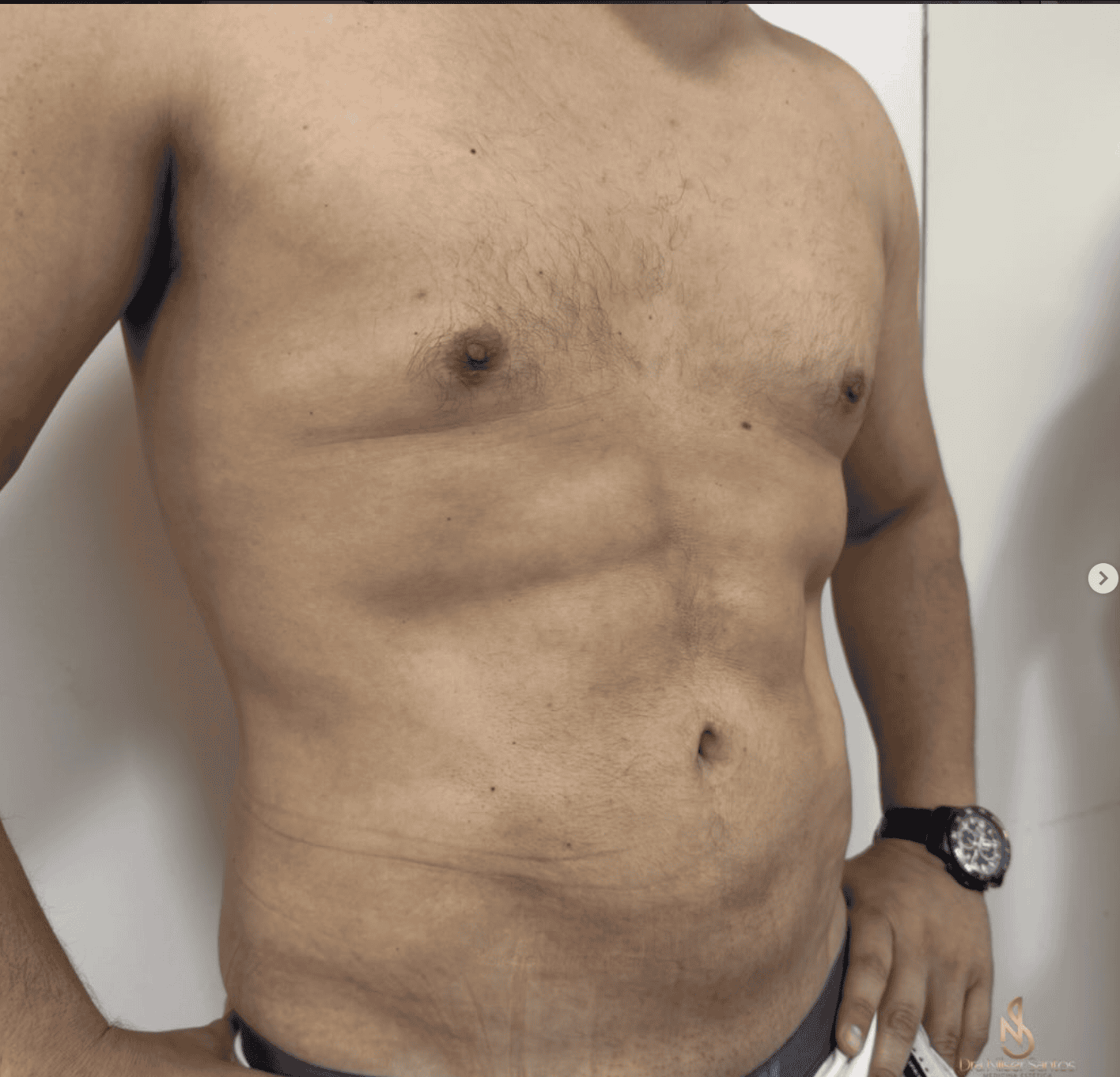 Resultado de marcación HD en abdomen masculino